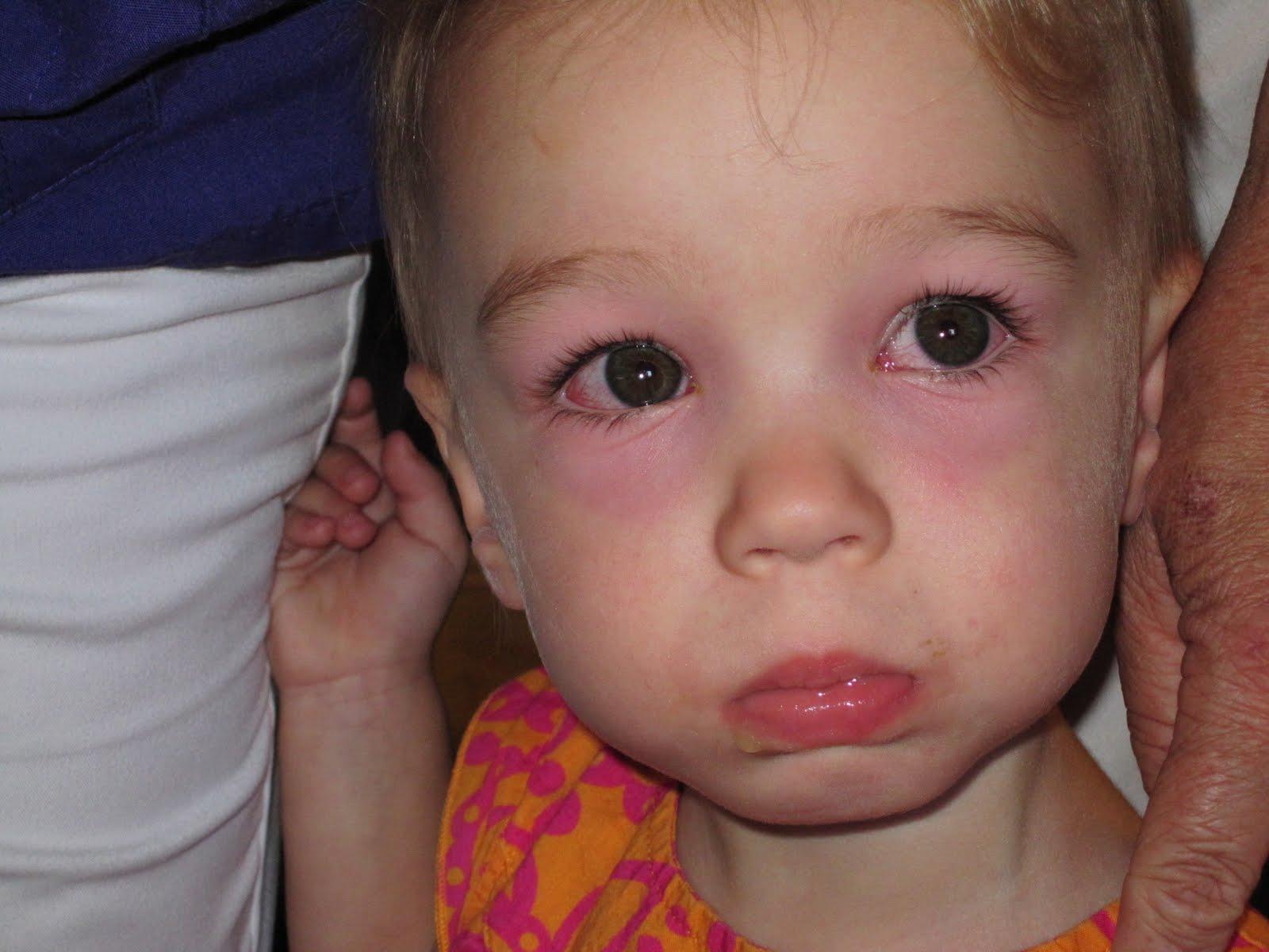 Pink Eye: Usually Mild and Easy to Treat | Features | CDC