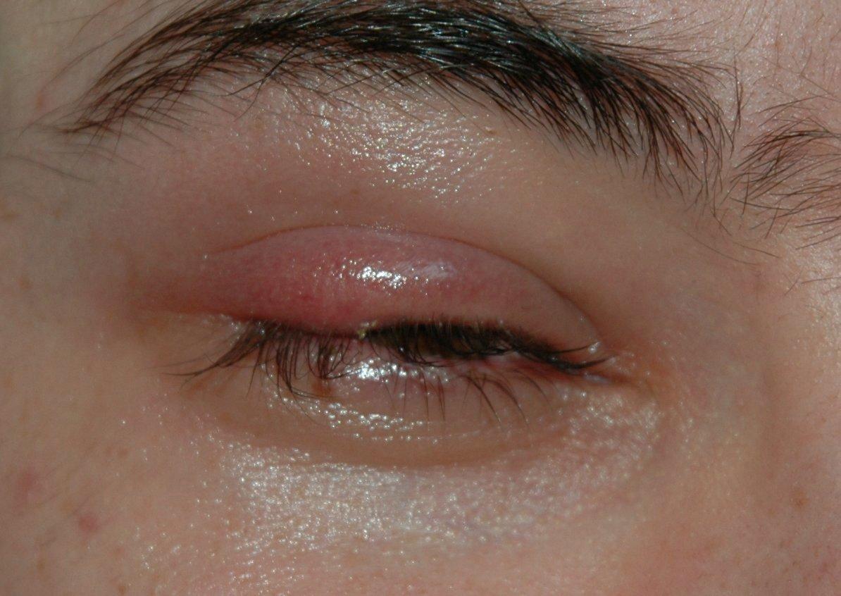 What are the treatment options for a sty in the eye?